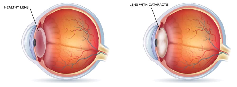 Cataracts