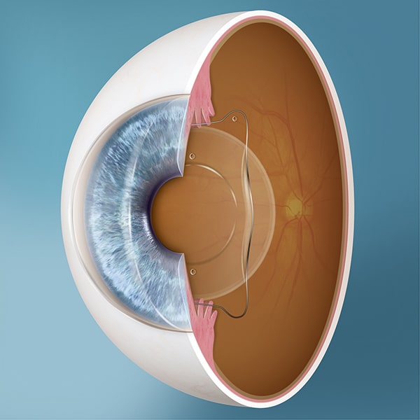 Cross Section Visian ICL in eye
