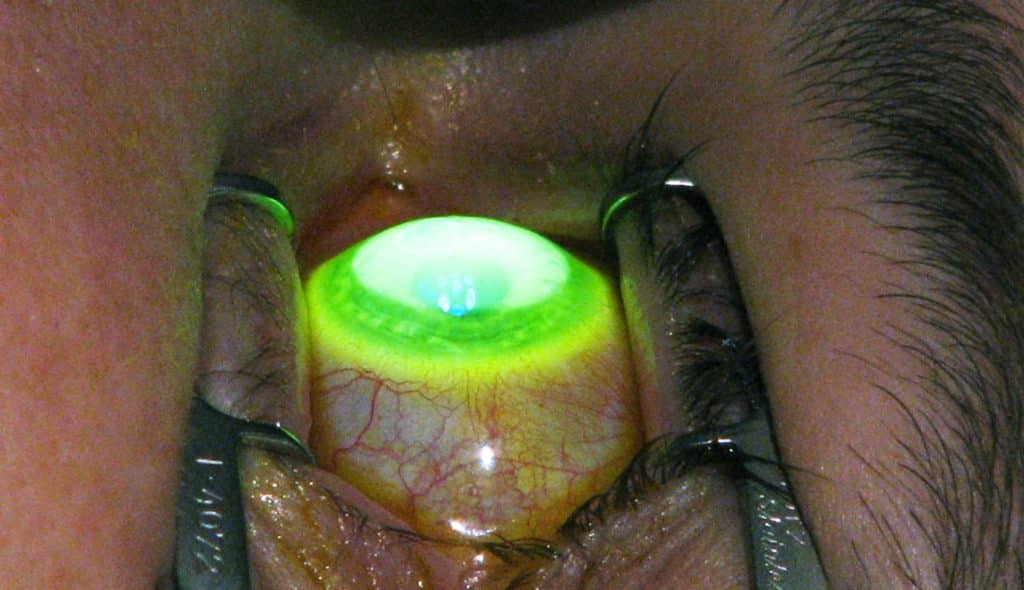 Cornea crosslinking treatment