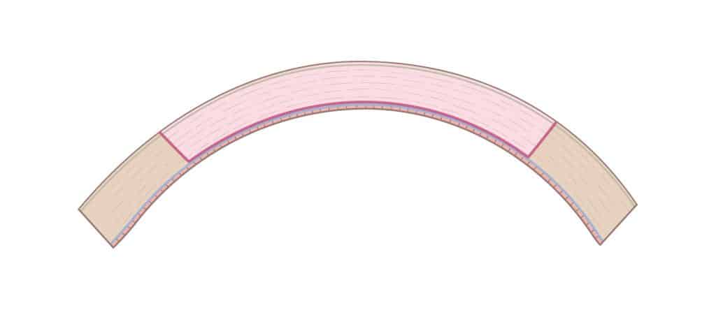 Deep anterior lamellar keratoplasty diagram
