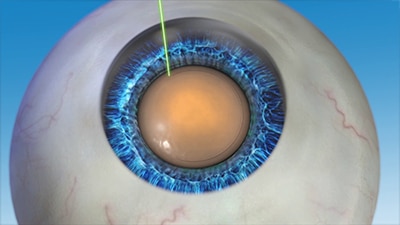 The LENSAR laser creates an opening in the capsule