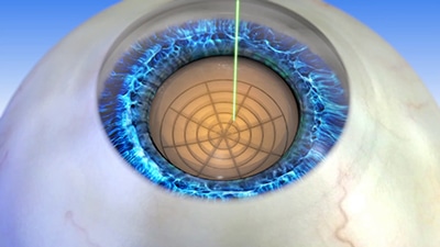 Laser fragmentation softens the lens