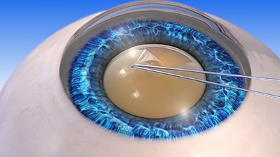 Manual removal of anterior capsule (capsulorhexis)