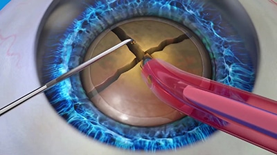 Manual cataract surgery uses phacoemulsification
