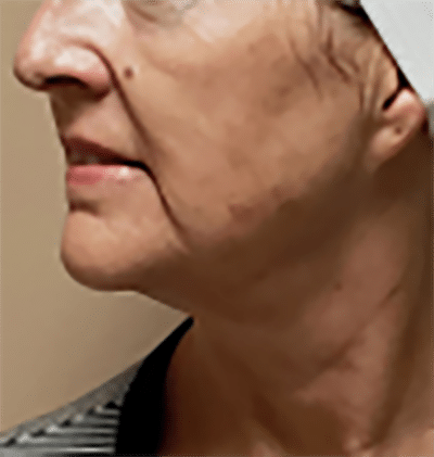 Morpheus8 patient 1 after treatment