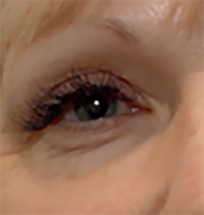 Morpheus8 patient 2 after treatment