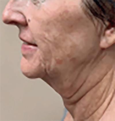 Morpheus8 patient 1 before treatment