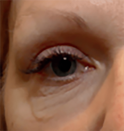 Morpheus8 patient 2 before treatment