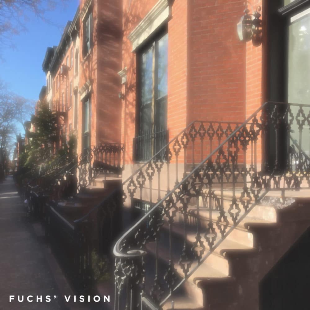 Brooklyn street seen with Fuchs’ Dystrophy before DMEK
