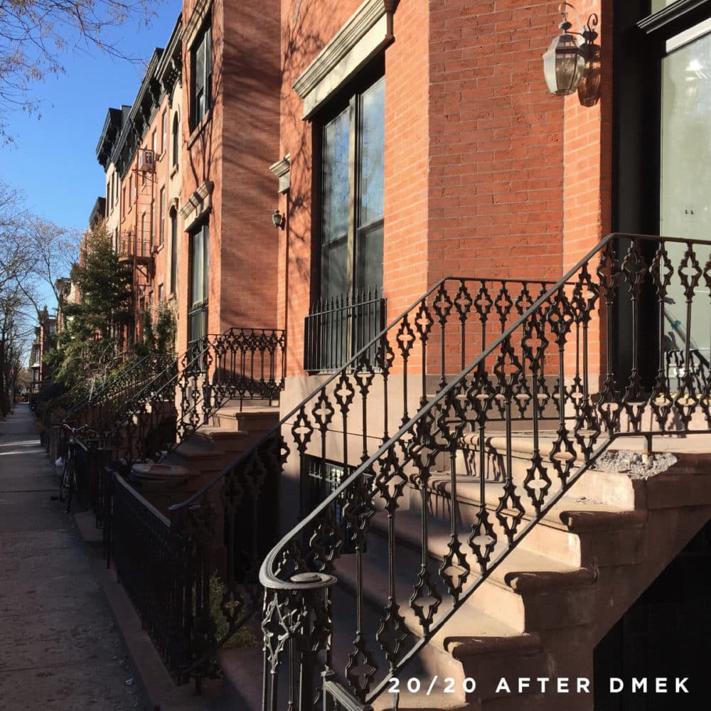 Brooklyn street seen after DMEK