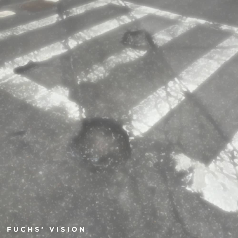 Potholes seen with Fuchs’ Dystrophy before DMEK