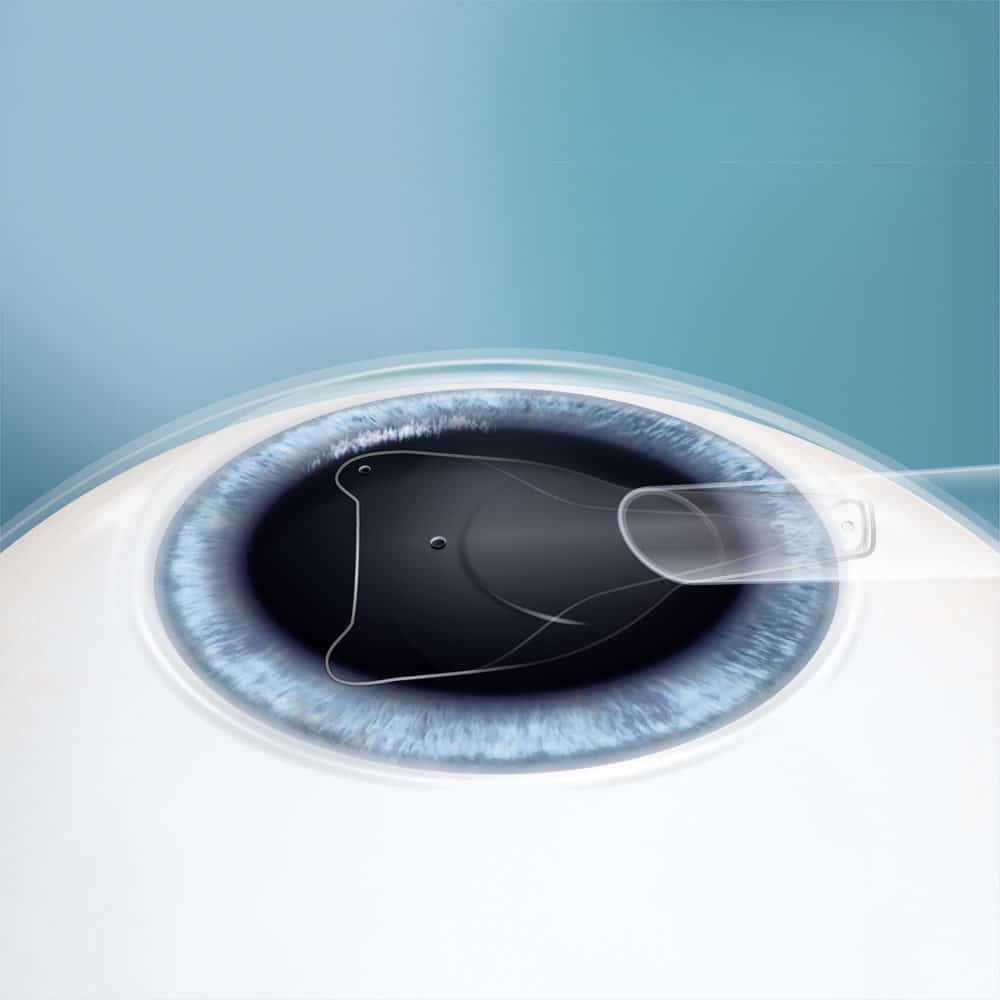 A microscopic, self-sealing incision is made and the lens will be injected into place.
