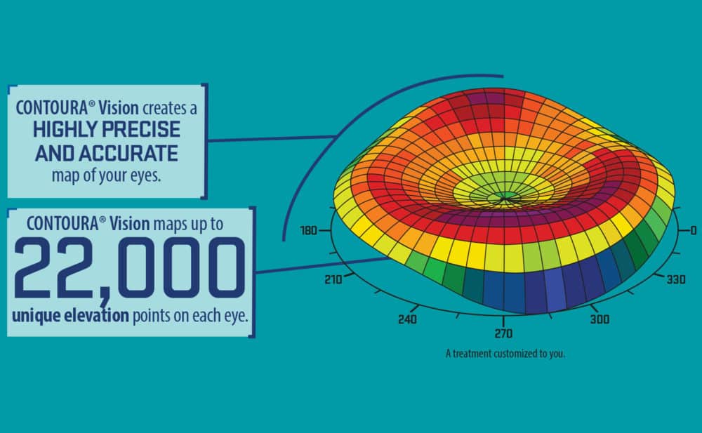 CONTOURA Vision LASIK scans 22,000 points