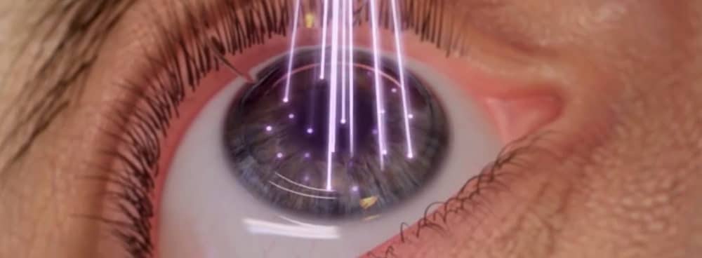 Excimer Laser