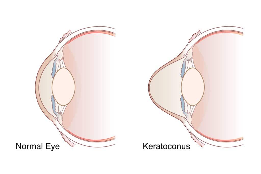 Comparison of a normal cornea and a cornea with keratoconus