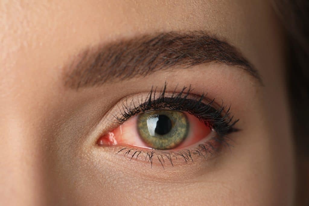 What is dry eye? Price Vision Group explains