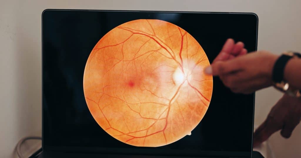 What is glaucoma? Price Vision Group explains