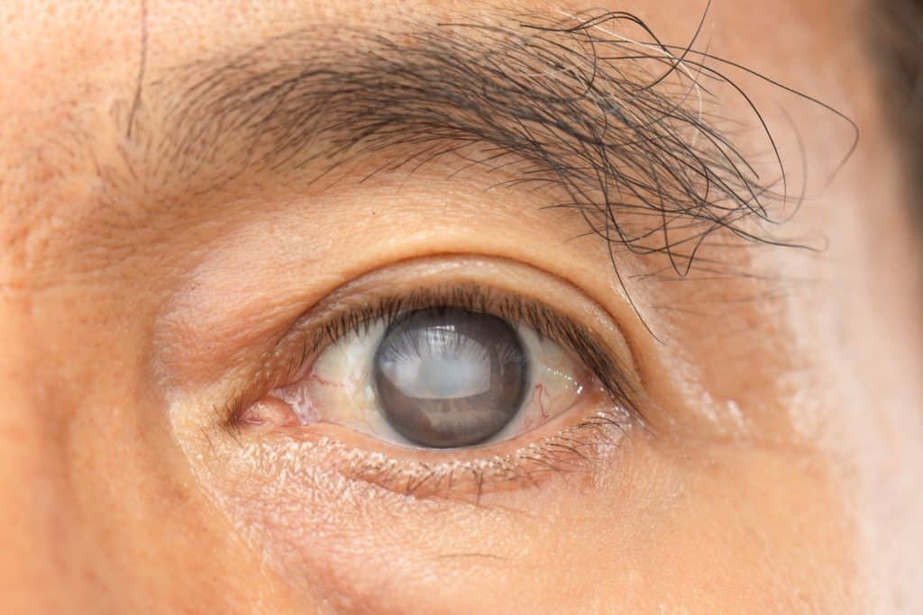 What is a cataract? Price Vision Group explains