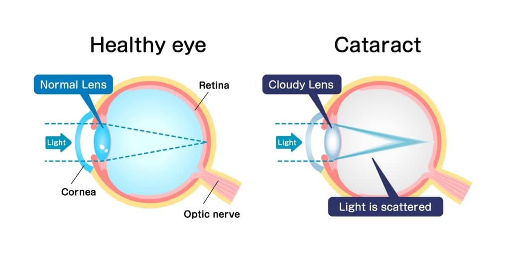 Illustration comparing a healthy eye and an eye with a cataract