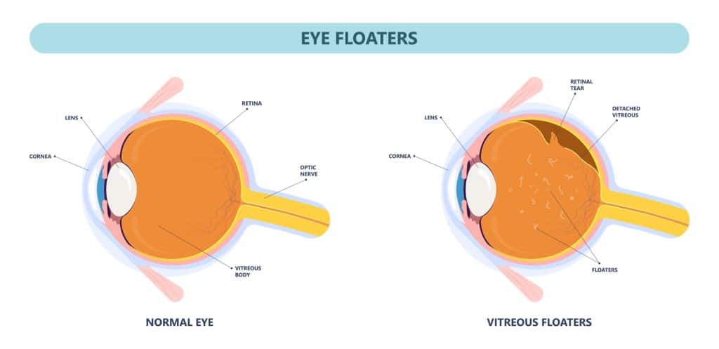 Illustration of eye floaters