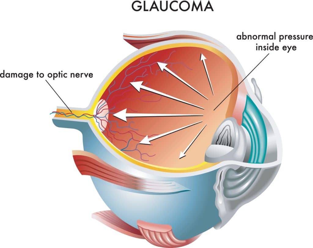 Illustration of eye pressure damaging the optic nerve