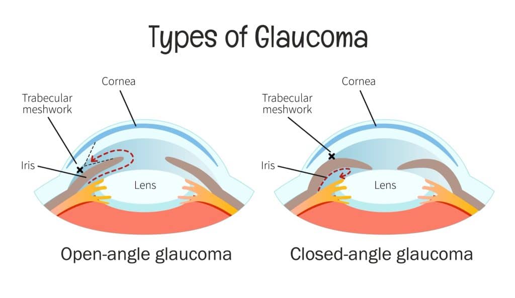 Illustration of open-angle and closed-angle glaucoma