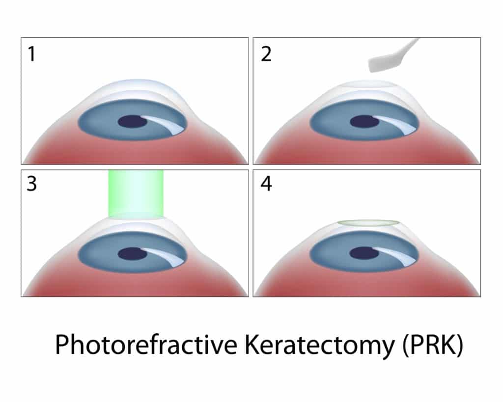 Illustration of photorefractive keratectomy steps