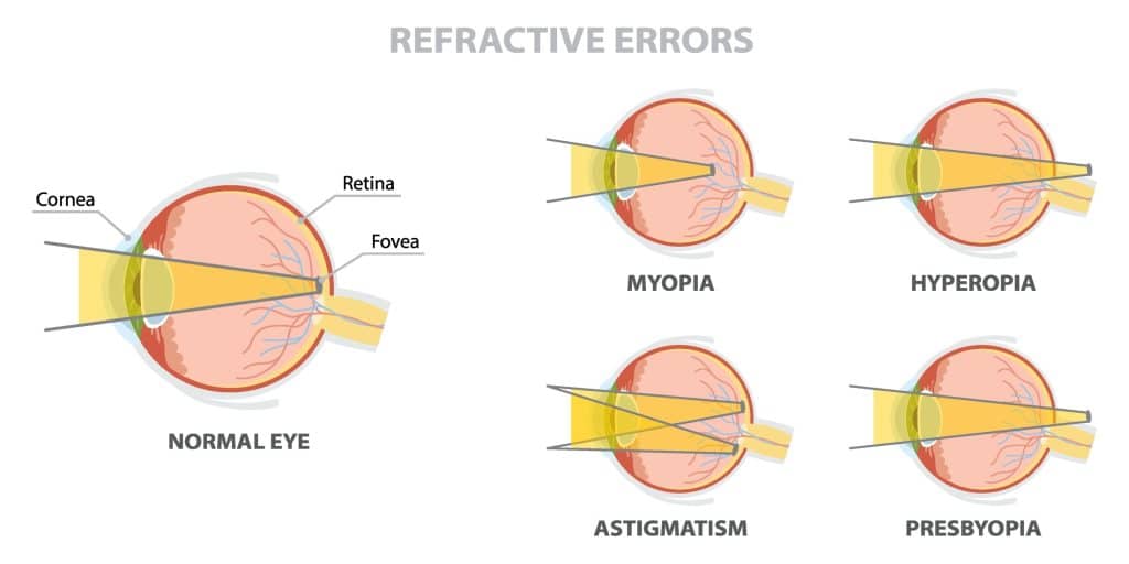 Illustration of refractive errors