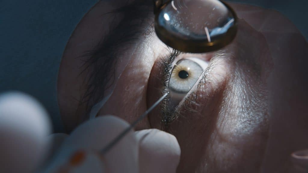 Close-up of a lens over the cornea during an eye procedure
