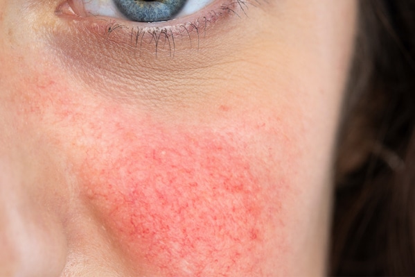 Rosacea